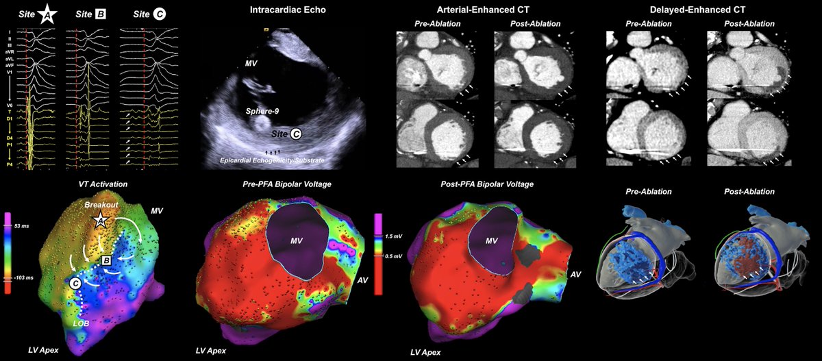 Pasquale Santangeli (@dr_santangeli) on Twitter photo Elimination of Epicardial Scar-Related Ventricular Tachycardia With Endocardial Pulsed Field Ablation: First Clinical Report <a href="/CleClinicHVTI/">Cleveland Clinic Heart, Vascular & Thoracic</a> <a href="/omwazni/">Oussama Wazni</a> <a href="/SroubekJ/">Jakub Sroubek</a> ahajournals.org/doi/10.1161/CI… Elimination of Epicardial Scar-Related Ventricular Tachycardia With Endocardial Pulsed Field Ablation: First Clinical Report <a href="/CleClinicHVTI/">Cleveland Clinic Heart, Vascular & Thoracic</a> <a href="/omwazni/">Oussama Wazni</a> <a href="/SroubekJ/">Jakub Sroubek</a> ahajournals.org/doi/10.1161/CI…