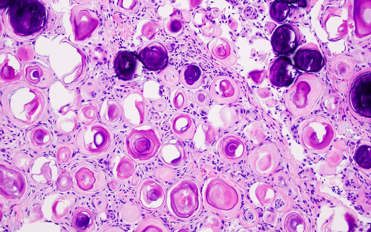 JaredAhrendsen's tweet image. Can you make a #diagnosis of this tumor with nothing but a single H&amp;amp;E image? (Coming from me, at least you can reasonably assume it’s #neuropath related!). 🧠🔬