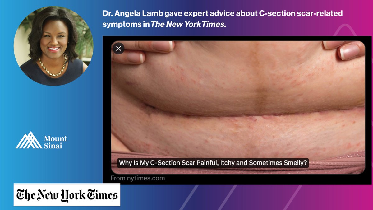 Our <a href="/AngelaLambMD/">Angela Lamb, MD</a> gave expert advice about C-section scar-related symptoms in The New York Times. “If the itching is intense or your skin is red and blistery, consult your doctor.” Read the article: bit.ly/3YZtTWi
<a href="/IcahnMountSinai/">Icahn School of Medicine at Mount Sinai</a> <a href="/EmmaGuttman/">Emma Guttman-Yassky</a>