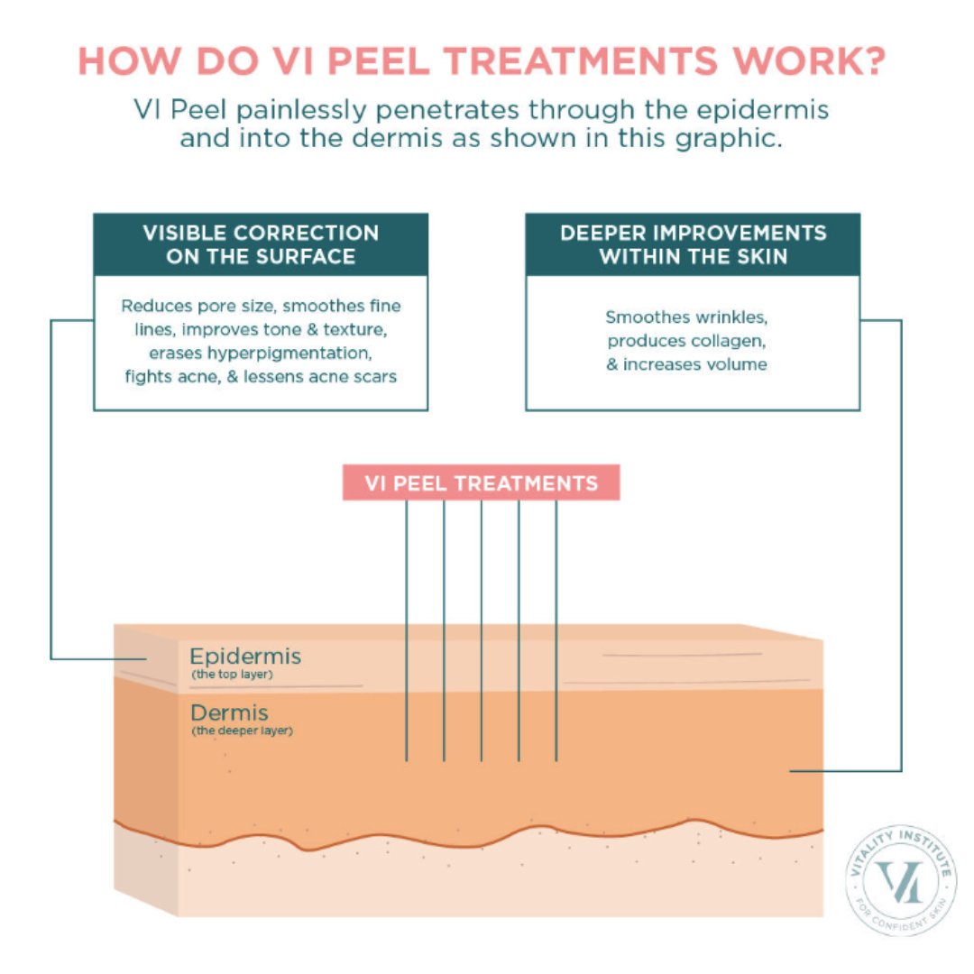 SpaVieMedSpa's tweet photo. These powerful peels exfoliate the skin by removing damaged layers, boosting cell turnover, and stimulating collagen production. The result? A clearer, smoother, and more youthful complexion! Perfect for tackling fine lines, acne scars, and uneven skin tone. ✨ https://t.co/XjVODb8Cle