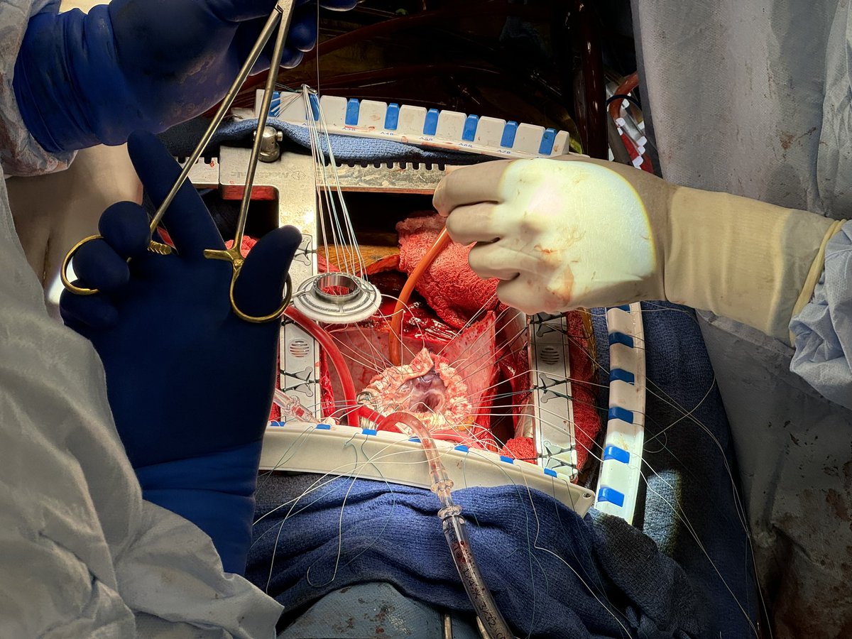 Antonio Polanco, MD (@apolancomd) on Twitter photo Sensitized patients with biventricular shock and VT have very few options. Recently, <a href="/cpasrij/">Chetan Pasrija</a> and I elected to use 2 HM3s or a HM6 as a TAH. Thanks to the entire <a href="/hopkinsheart/">Johns Hopkins Cardiology</a> HF group for continuing to support giving high risk patients options. Sensitized patients with biventricular shock and VT have very few options. Recently, <a href="/cpasrij/">Chetan Pasrija</a> and I elected to use 2 HM3s or a HM6 as a TAH. Thanks to the entire <a href="/hopkinsheart/">Johns Hopkins Cardiology</a> HF group for continuing to support giving high risk patients options.
