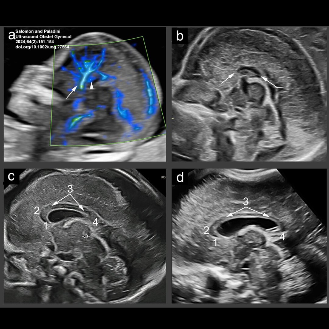 ISUOG's tweet photo. Salomon and Paladini discuss prenatal imaging of the corpus callosum and the differentiation of corpus callosal abnormalities in their Opinion article, featured in the August #UOGJournal. Access the article here: https://t.co/jqp0LVVYSR @WileyHealth https://t.co/gJhbLfHqzZ