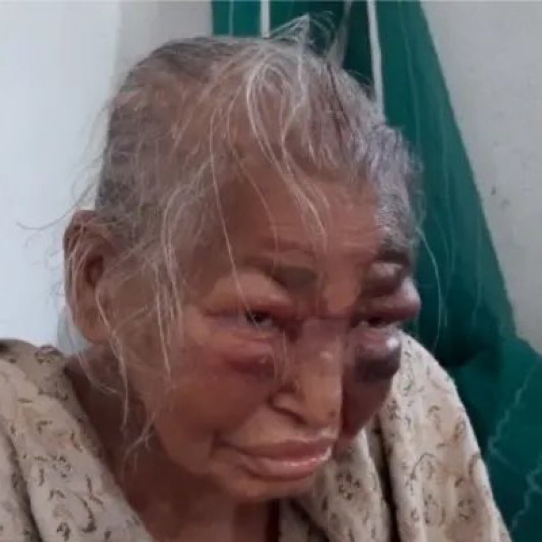 MumukshuSavitri's tweet photo. This is the late Shobha Majumdar of Bengal. In 2021 the elderly lady was brutally thrashed on every part of her body  by Mamata’s TMC goons just because her son Gopal Mazumdar was a BJP worker. Many of us saw the heartbreaking video of her weeping with injuries all over her face and head. She died hours later. But you never saw Rajdeep preaching about the injustice of this horrific incident. 

When scum without any integrity preach as the nation’s conscience keepers.