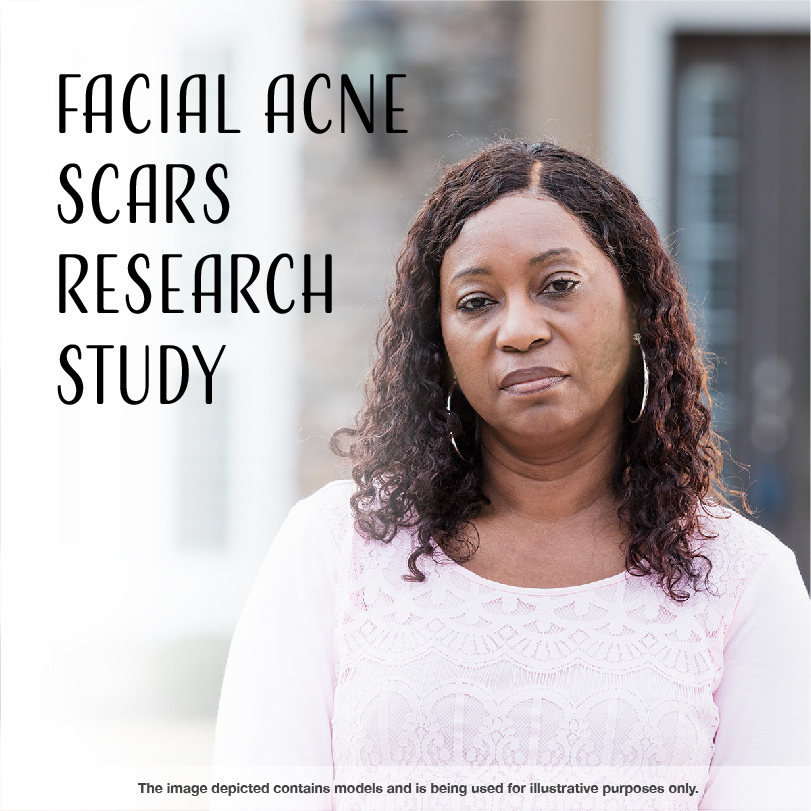 AcneScarStudy's tweet image. There could be better options for facial acne scars for us and future generations—participate in clinical research to get us closer to that reality. A local research study is now enrolling adults with moderate to severe facial acne scars.