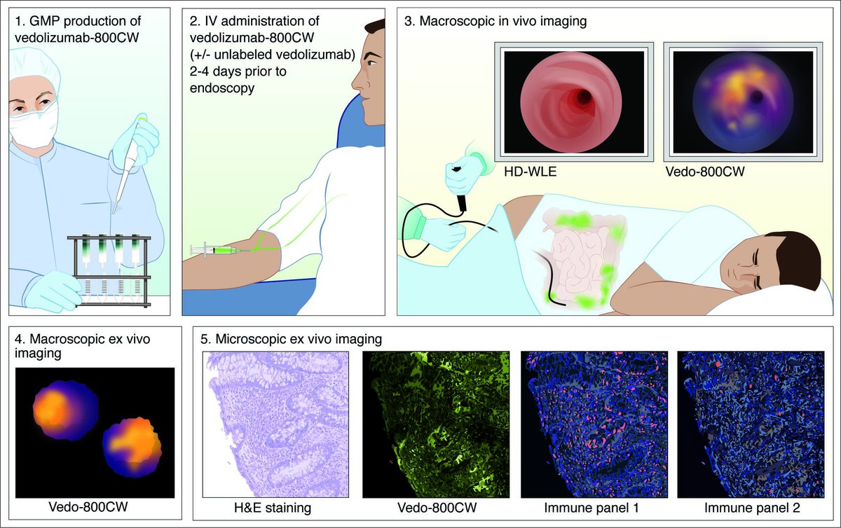 Gut Journal (@gut_bmj) on Twitter photo #GUTImage from the paper by Gabriels et al entitled
"Fluorescently labelled vedolizumab to visualise drug distribution and mucosal target cells in inflammatory bowel disease" via
bit.ly/3YIzWP0
<a href="/wouternagengast/">wouter nagengast</a> <a href="/researchumcg/">Research UMCG</a> #IBD #Vedolizumab #GUTImage from the paper by Gabriels et al entitled
"Fluorescently labelled vedolizumab to visualise drug distribution and mucosal target cells in inflammatory bowel disease" via
bit.ly/3YIzWP0
<a href="/wouternagengast/">wouter nagengast</a> <a href="/researchumcg/">Research UMCG</a> #IBD #Vedolizumab