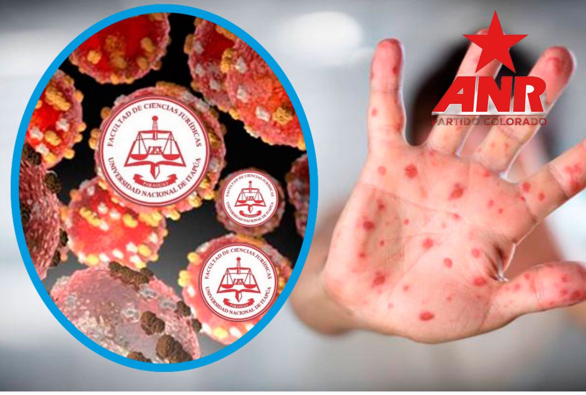 🚨🚨🚨Se reportan los primeros casos de viruela del mono🚨🚨🚨