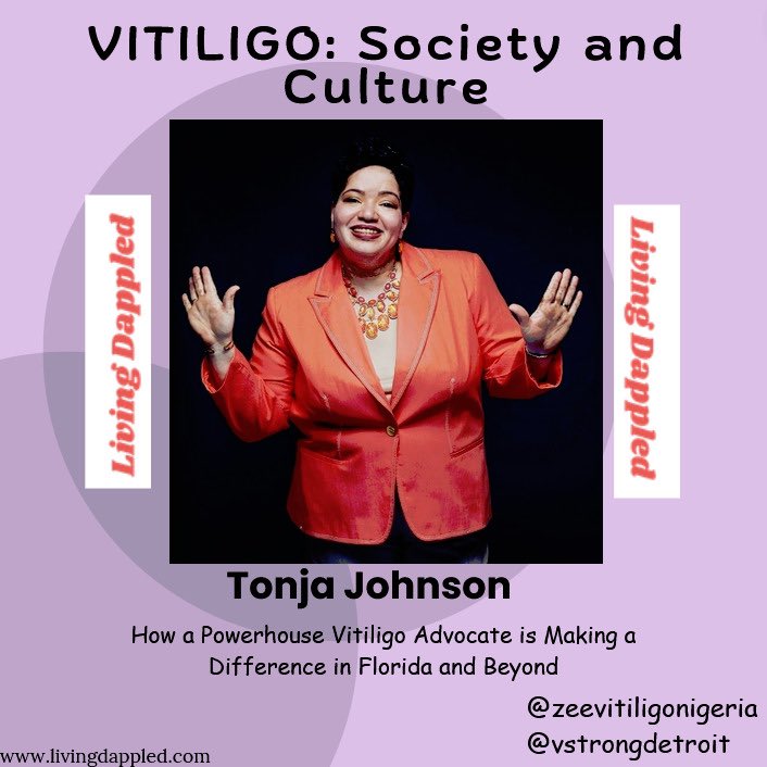 zeevitiligo's tweet image. Have you heard about @tonjaljohnson How a Powerhouse Vitiligo Advocate is Making a Difference in Florida and Beyond . Check out @livingdappled blog to learn more💜💟
