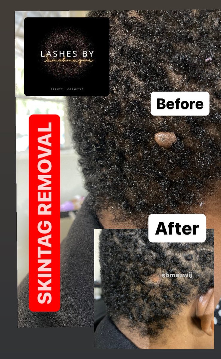 iamsbmazwi's tweet photo. Being bothered by skintags (iintsumpa)? Look no further. Call/ WhatsApp Sibu on 0615885177 to get yours removed TODAY! #painfreeskintagremoval #skintagroval #removalofskintags #skintags #iintsumparemoval #nomorekintags #nomorentsumpa #clearskin #smoothskin https://t.co/EaEJYEF3FW