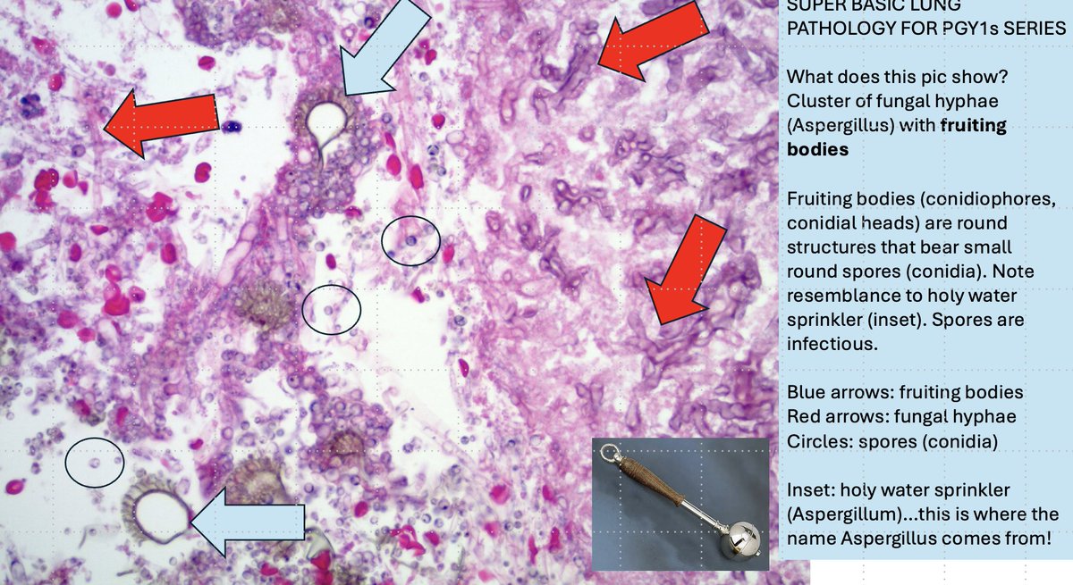 smlungpathguy's tweet image. 27. PGY1s: do you know what fruiting bodies are? If you see these in surgical pathology or cytology, you should strongly suspect Aspergillus!

#pathbugs #crittersontwitter #sblppgy1