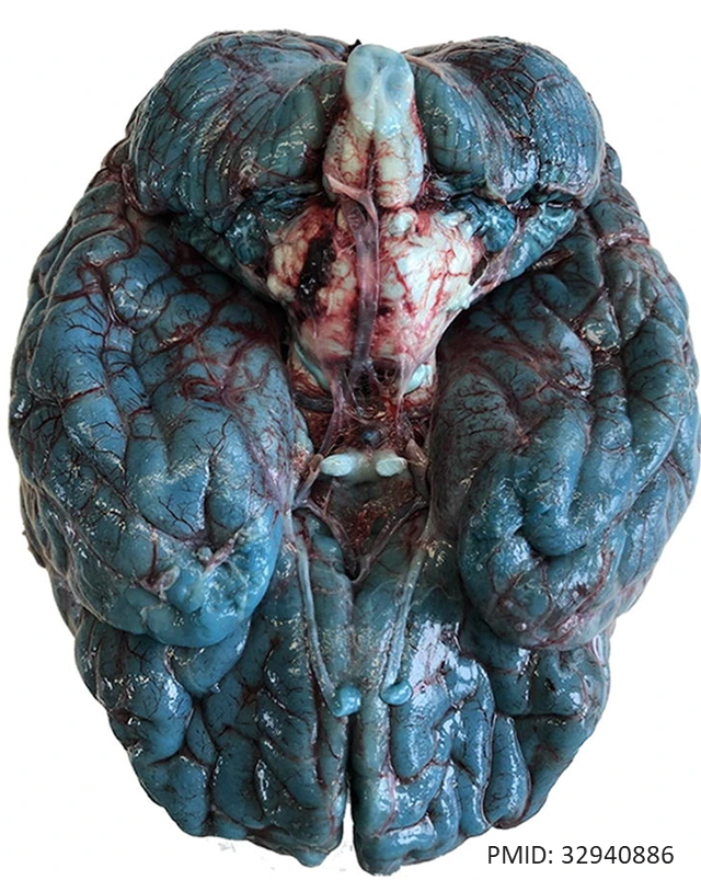 DrCycloPath's tweet photo. "Avatar" brain. Cause?
A) Carbon monoxide poisoning
B) Methanol poisoning
C) Cyanide poisoning
D) Iatrogenic
#Neuropathology #Forensics #pathology #pathologists #PathTwitter https://t.co/vChFlFuER5