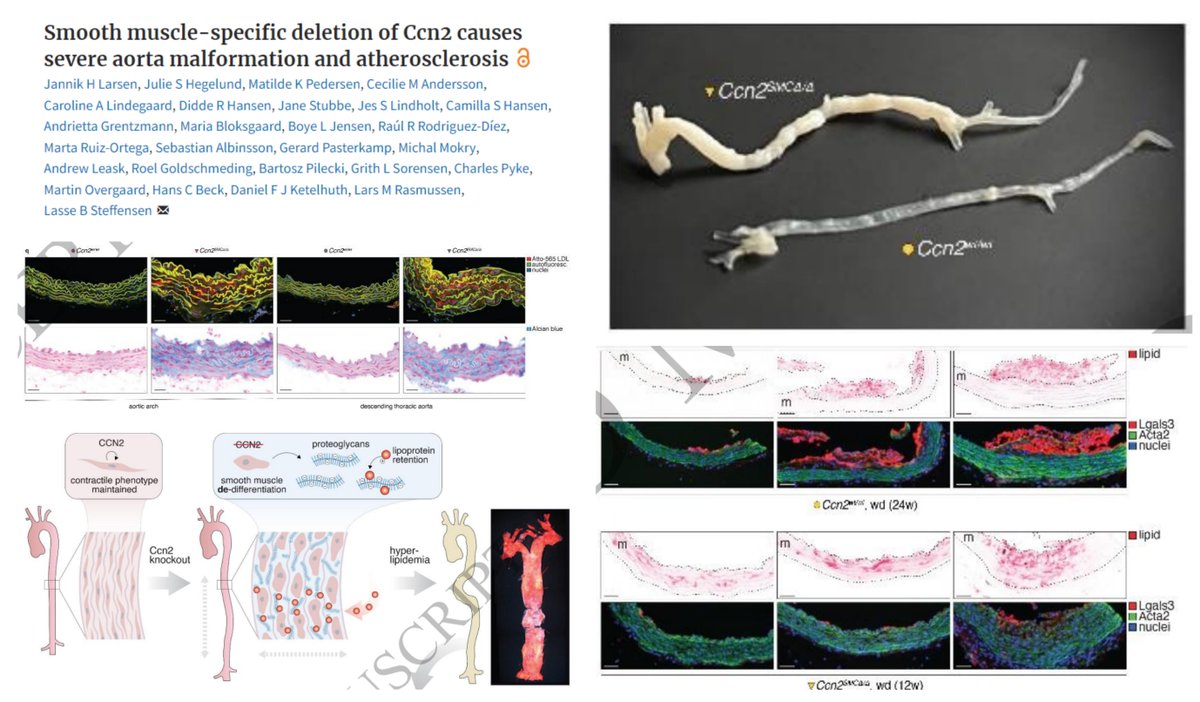 HaoYin20's tweet photo. #SmoothMuscleCell #Atherosclerosis
SMC CCN2/CTGF KO creates a striking #Glycosaminoglycan-depositing & LDL-entrapping, pro-atherogenic phenotype😎◀️What is the cellular mechanism?🧐
What a crazy Fatty mouse Aorta!🤯
@_lassebs #CardiovascRes 2024 @ESC_Journals
https://t.co/cpTdp9liur