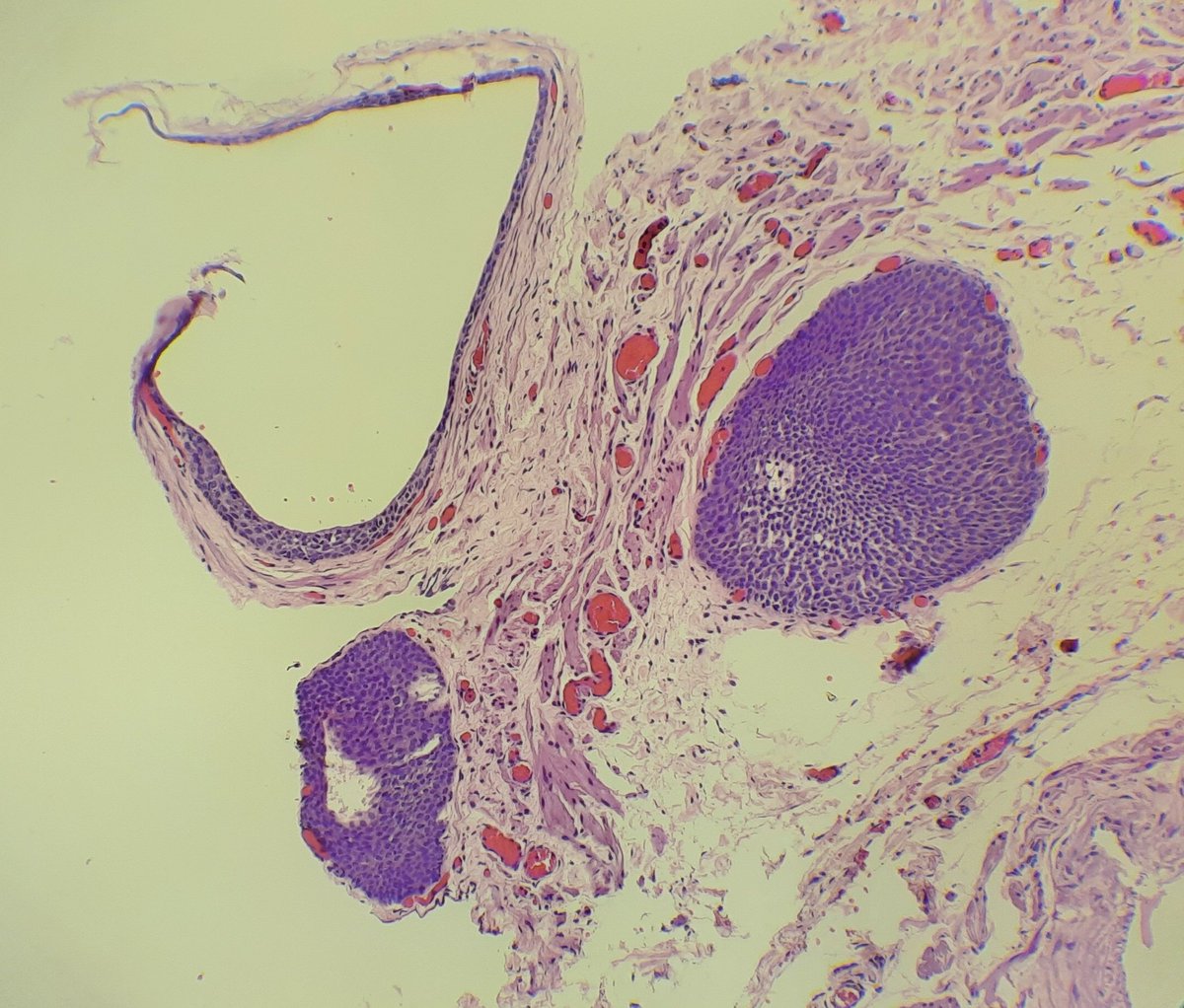 Sheelashree5's tweet photo. Solid nests and cysts of transitional type epithelium- Walthard cell nests, named after Swiss gynecologist Max Walthard https://t.co/2xEoMQD1cC