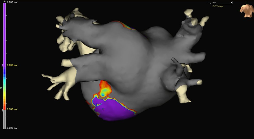 Highlighting one of our latest articles: First-in-man intraoperative EP mapping with the EnCompass Clamp during Cox-IV Maze! 

Achieved 88% reduction in high-voltage atrial areas—precision in action! 

How will EP mapping impact future cardiac surgeries?

Read Full Article Here:
