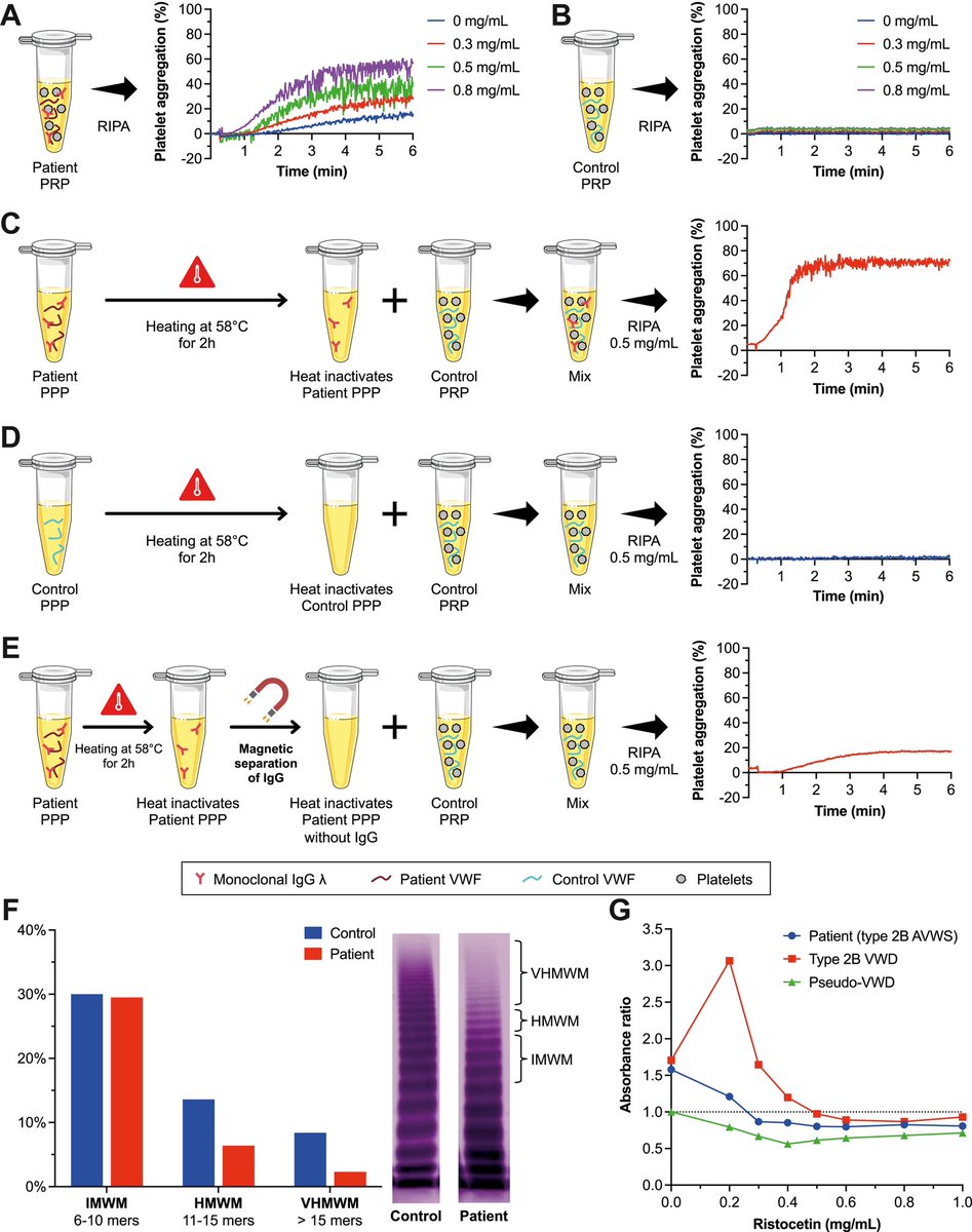 An interesting case report of acquired von Willebrand syndrome (#AVWS) with a #VWD type 2B phenotype. This is the 3rd case report of type 2B AVWS.Monoclonal IgG was found to causes #VWF conformational change. <a href="/RPTHjournal/">RPTH</a> 
rpthjournal.org/article/S2475-…
