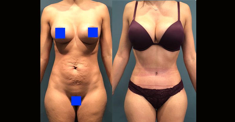 DrSej's tweet photo. 1. Low Hidden Incision
2. Muscle Tightening
3. Mons Lift
4. Minimal Scar Belly Button