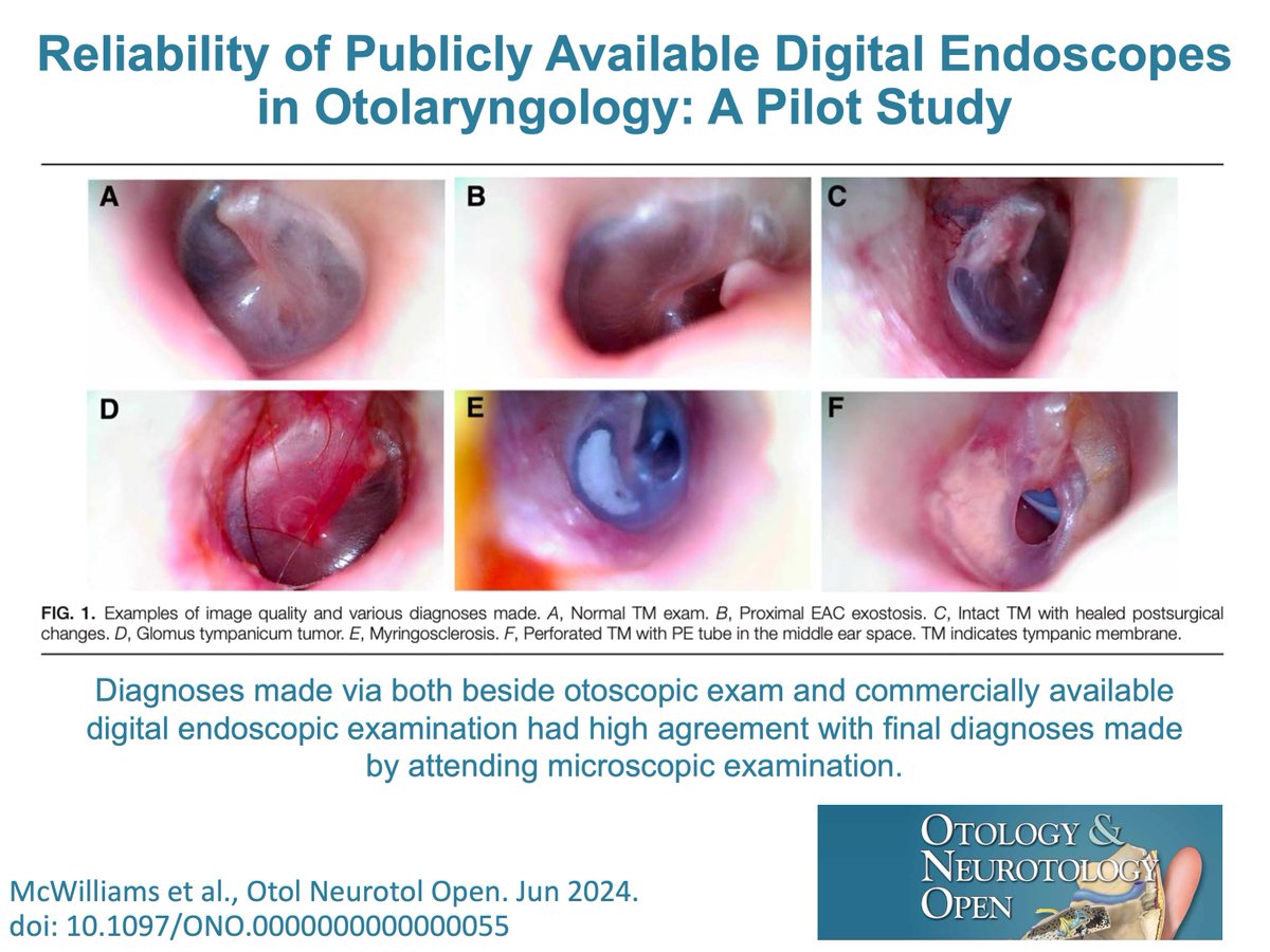 Otology & Neurotology Open (@onojournal) on Twitter photo Is there a role for commercially available digital endoscopes in otolaryngology patient care and resident education? Click here to find out: ow.ly/qLxm50T9Vj2 #Otology #EarEndoscopy <a href="/wkhealth/">WoltersKluwerHealth</a> <a href="/lippincott/">life</a> <a href="/OandNonline/">Otology&Neurotology</a> Is there a role for commercially available digital endoscopes in otolaryngology patient care and resident education? Click here to find out: ow.ly/qLxm50T9Vj2 #Otology #EarEndoscopy <a href="/wkhealth/">WoltersKluwerHealth</a> <a href="/lippincott/">life</a> <a href="/OandNonline/">Otology&Neurotology</a>