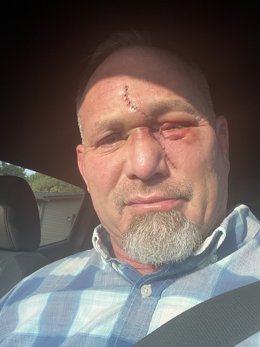 bdckool's tweet photo. Day 3 post op….. swollen, black eyes and a hella long scar….. back to work Frankenstein style lol!!! Gotta keep marching forward!! It’s a good day! Sun is bright and I am blessed….. 👊🏻😎 #Actor #SkinCancer #BasalCell https://t.co/dnr2AvRyUm