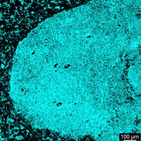 A new  #AI tool, called APOLLO, can sift through spectral data derived from brain tumor tissue to reveal a wealth of information, including gene activations and mutations, and even which lipid molecules are present in the tumors. Learn more:  go.nih.gov/bxoVN1l