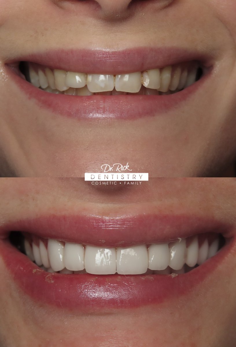 DrRickDentistry's tweet photo. This was the smile she was meant to have😍 How good is this smile transformation?!
You too can have the smile of your dreams! Let's talk!📱480-585-4244
#smilemakeover #smiledesigner #smiledesign #beforeandafter #newsmile #veneers #porcelainveneers #cosmeticdentistry https://t.co/Itq46Gstfj