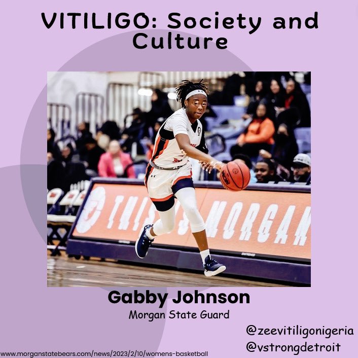 zeevitiligo's tweet image. Gabrielle
Johnson 💜💟💕

#vitiligo #vitiligoawareness