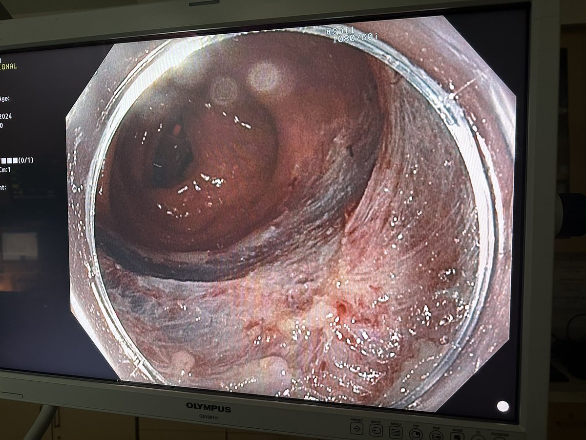 WJuakiem's tweet photo. Just got my hands on the Hedgehog snare by Microtech - it's a game-changer for mucosal purchase in fibrotic areas! 💪 Who else is using this tool? 

Almost Michael Bourke worthy
Always STSC #endoscopy #GITwitter #MedED #GIFellows @MicroTechEndo https://t.co/zQFjjDftl1
