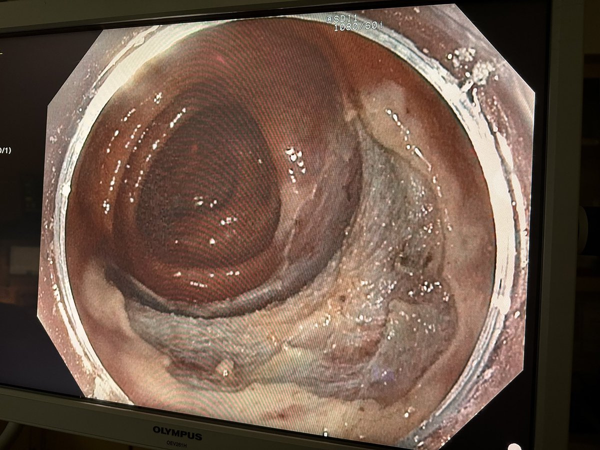 WJuakiem's tweet photo. Just got my hands on the Hedgehog snare by Microtech - it's a game-changer for mucosal purchase in fibrotic areas! 💪 Who else is using this tool? 

Almost Michael Bourke worthy
Always STSC #endoscopy #GITwitter #MedED #GIFellows @MicroTechEndo https://t.co/zQFjjDftl1