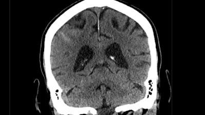 Radiology: Artificial Intelligence (@radiology_ai) on Twitter photo #DeepLearning to Detect Intracranial Hemorrhage in a National Teleradiology Program and the Impact on Interpretation Time doi.org/10.1148/ryai.2… <a href="/VAPaloAlto/">VA Palo Alto HCS</a> <a href="/StanfordRad/">Stanford Radiology</a> #AI #ML #MachineLearning #DeepLearning to Detect Intracranial Hemorrhage in a National Teleradiology Program and the Impact on Interpretation Time doi.org/10.1148/ryai.2… <a href="/VAPaloAlto/">VA Palo Alto HCS</a> <a href="/StanfordRad/">Stanford Radiology</a> #AI #ML #MachineLearning