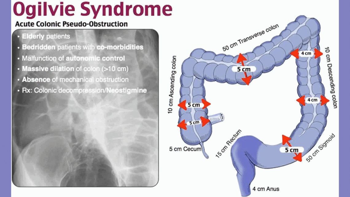 Iatrogenic Ogilvie Syndrome – Hpathy.com buff.ly/4fPi37c