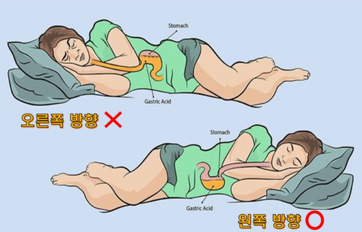 내가 약국에서 제일 많이 하는 말 중 하나!

“자극적인 음식(맵,짠,신,단) 먹지마시고 술, 담배 하지 마시고 커피, 밀가루 음식, 기름진 음식은 줄이시는 게 좋습니다! 밥 먹고 바로 눕지 마시고 야식은 절대 안됩니다!”

역류성식도염이나 만성위염 환자에게 복약지도하면서 하는 말이다. 스트레스