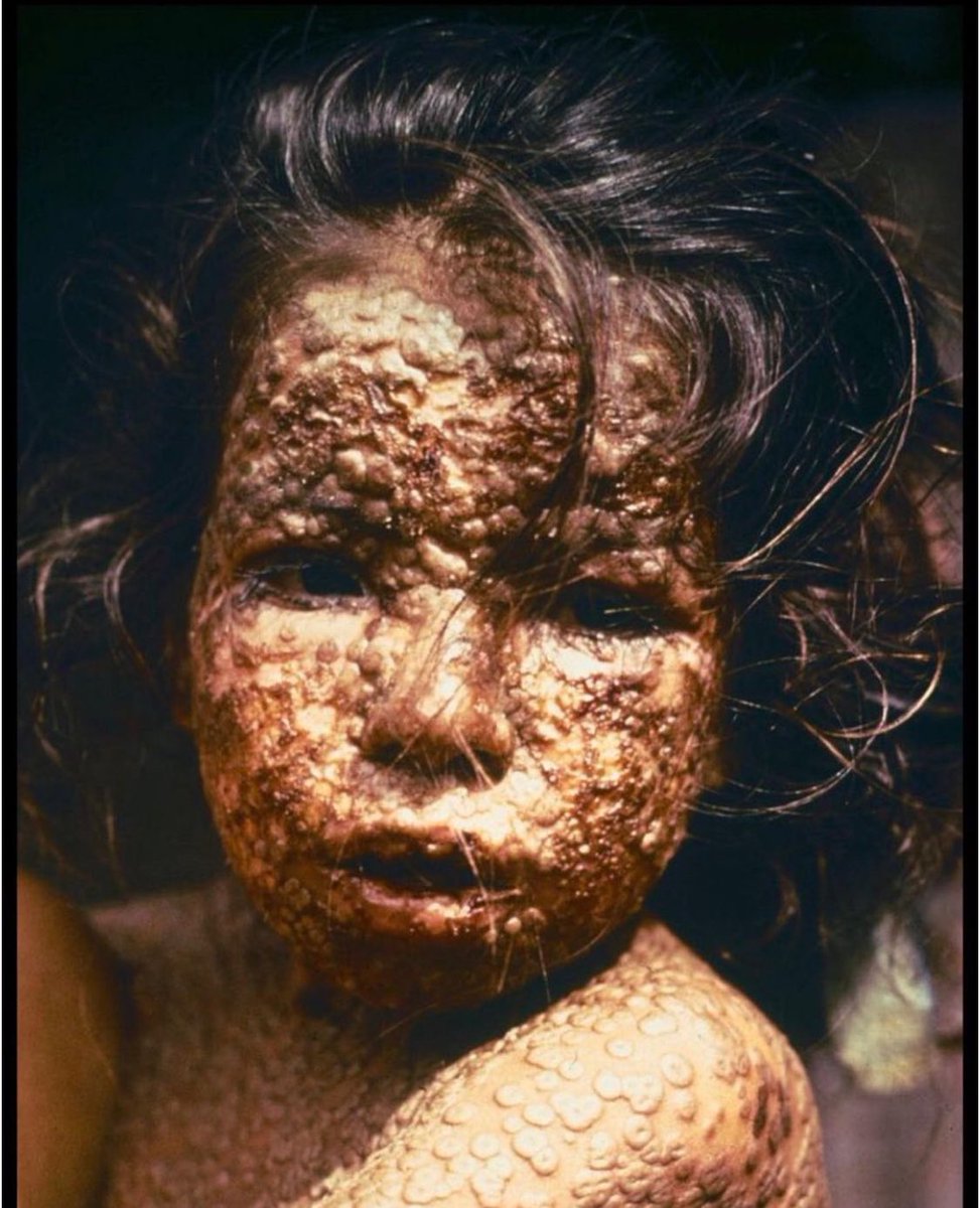 FriendsofGRI's tweet photo. 🦠Smallpox💉🐄 

The only human disease to have been eradicated. 

High mortality &amp; devastating effects on victims.

Last Glasgow outbreak, March 1950.

Triggered mass quarantine &amp; vaccination. With parallels to the 2020 C19 pandemic😷

Exhibition opens in October. Come along 🙏 https://t.co/riZ21vGCEZ