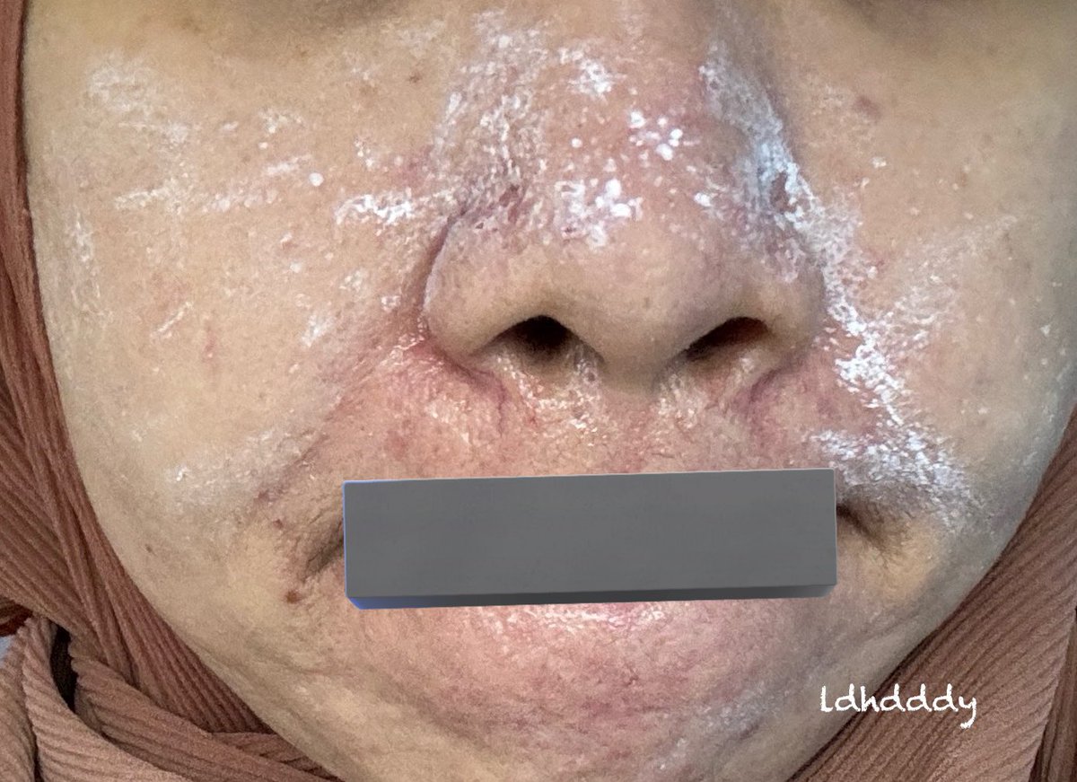 I may not have perfect or glass skin but I’m still proud of my skin. Pergi facial just to boost my skin and this is me right after my scar treatment (right pic) ☺️

Before this lagi teruk (left pic) and now look at my skin, yang penting jerawat pun dah kurang🥹