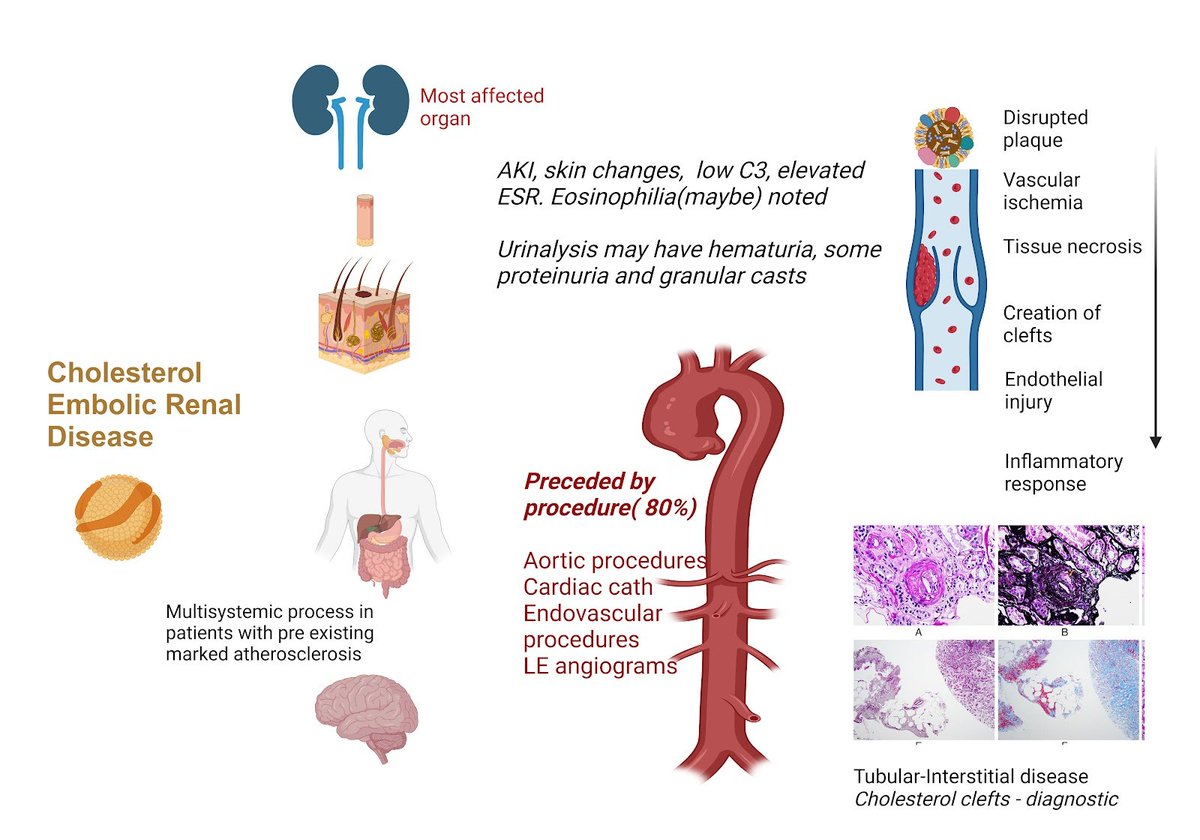 kdjhaveri's tweet photo. #nephronpower https://t.co/SQyZ04wf8x  Concept Map: Cholesterol Embolic Renal Disease https://t.co/5bbcMlxOzb