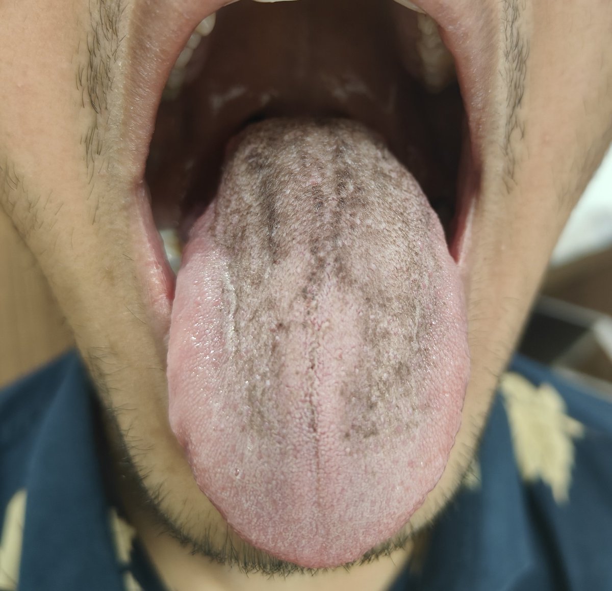 HKadnur's tweet photo. 22/M, Disseminated TB on Modified ATT due to DILI. Presenting with altered taste!
How common is this in your practice? How do you manage?
@nettomundadan @niyas987 @IDDoc_Mittal @adil_rashidk @ankeshg96565122 @dr_satish9
#twitterID #infectiousdiseases https://t.co/H57zvVGtqS