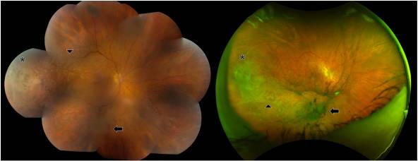 Mayo Clinic Department of Ophthalmology (@mayocliniceye) on Twitter photo Importance of including metastatic disease in the differential diagnosis of new visual floaters, blurred vision & other common ocular symptoms in patients with a history of cancer per <a href="/FairbanksEye/">Aaron Fairbanks MD</a> <a href="/DivaRSalomao/">Diva R. Salomao, MD</a> & <a href="/AndrewBarkmeier/">Andrew Barkmeier MD</a> in <a href="/AJOphthalmology/">American Journal of Ophthalmology</a>. bit.ly/4e6nqxk Importance of including metastatic disease in the differential diagnosis of new visual floaters, blurred vision & other common ocular symptoms in patients with a history of cancer per <a href="/FairbanksEye/">Aaron Fairbanks MD</a> <a href="/DivaRSalomao/">Diva R. Salomao, MD</a> & <a href="/AndrewBarkmeier/">Andrew Barkmeier MD</a> in <a href="/AJOphthalmology/">American Journal of Ophthalmology</a>. bit.ly/4e6nqxk