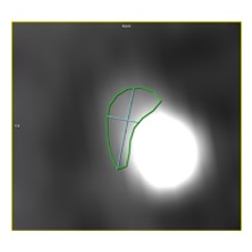 Nicolaj Støttrup (@nstoettrup) on Twitter photo 😀Great complex #PCI live-case for #csimic🇮🇳 with prof. <a href="/h_evald/">Evald Høj Christiansen</a> at <a href="/AUHdk/">Aarhus Uni.hospital</a>
#CCTA  confirmed heavy calcium🔨
Using IVUS HD #OptiCross we applied aggressive #calciummodification  using orbital #Atherectomy, #IVL and DK-CRUSH using <a href="/MerilLife/">Meril</a> Evermore 50
Excellent result👍
#CardioX 😀Great complex #PCI live-case for #csimic🇮🇳 with prof. <a href="/h_evald/">Evald Høj Christiansen</a> at <a href="/AUHdk/">Aarhus Uni.hospital</a>
#CCTA  confirmed heavy calcium🔨
Using IVUS HD #OptiCross we applied aggressive #calciummodification  using orbital #Atherectomy, #IVL and DK-CRUSH using <a href="/MerilLife/">Meril</a> Evermore 50
Excellent result👍
#CardioX