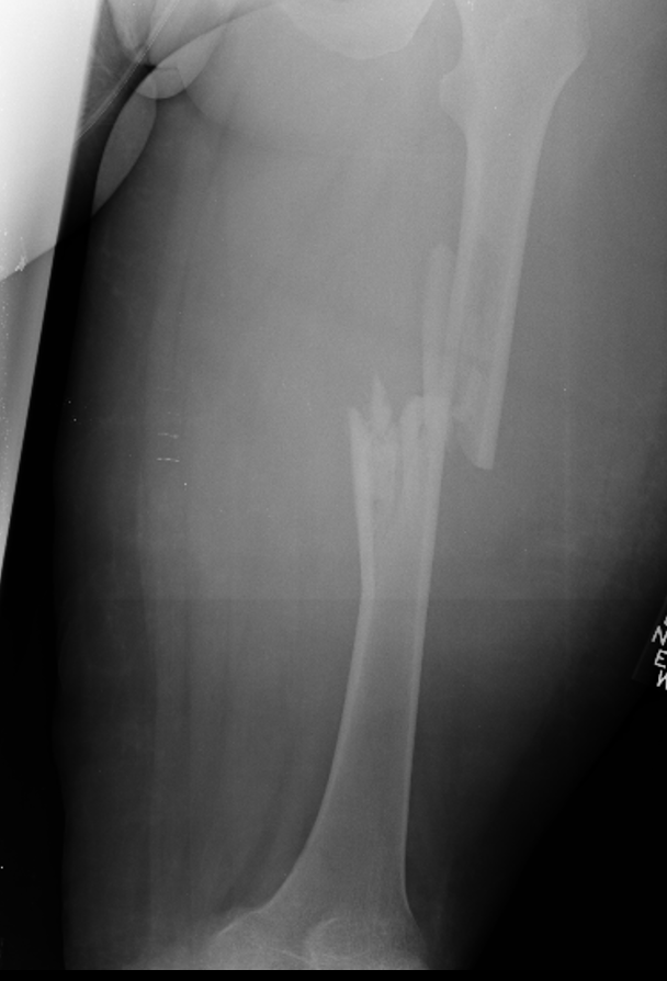 orthotraumamd's tweet photo. We are now well into the new academic year and wrapping up the first month for many orthopaedic trauma fellowships.

Sharing a case from our teaching files involving a femur fracture from a high-speed motor vehicle accident. 

What is your protocol for evaluating a high-energy femur fracture?

MRI? CT?

@MSOSOrtho @Inside_TheMatch @medbullets @orthobullets
