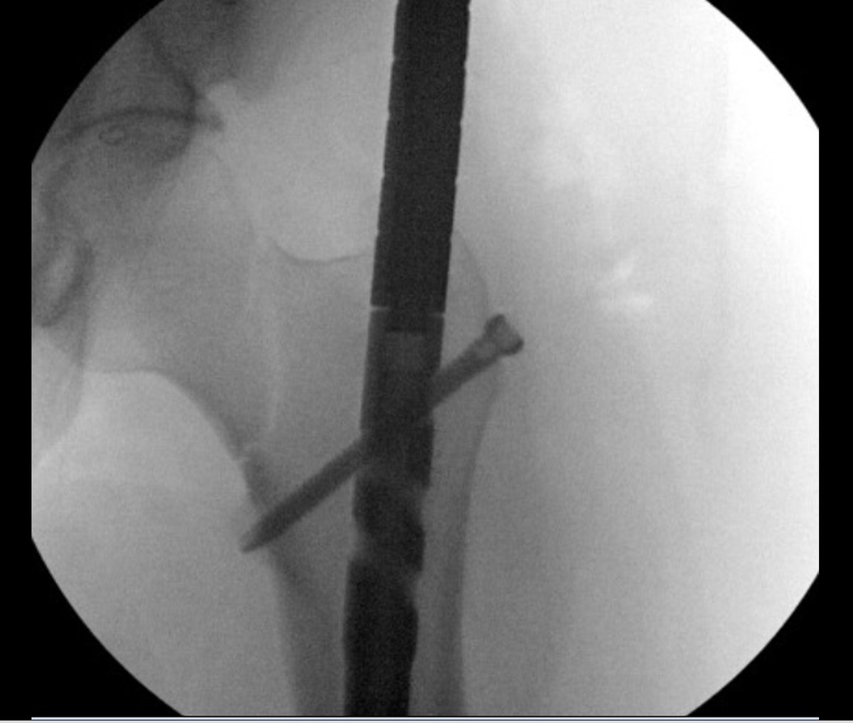 orthotraumamd's tweet photo. We are now well into the new academic year and wrapping up the first month for many orthopaedic trauma fellowships.

Sharing a case from our teaching files involving a femur fracture from a high-speed motor vehicle accident. 

What is your protocol for evaluating a high-energy femur fracture?

MRI? CT?

@MSOSOrtho @Inside_TheMatch @medbullets @orthobullets
