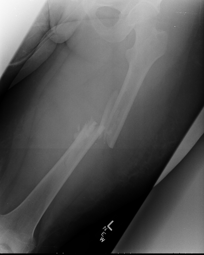 orthotraumamd's tweet photo. We are now well into the new academic year and wrapping up the first month for many orthopaedic trauma fellowships.

Sharing a case from our teaching files involving a femur fracture from a high-speed motor vehicle accident. 

What is your protocol for evaluating a high-energy femur fracture?

MRI? CT?

@MSOSOrtho @Inside_TheMatch @medbullets @orthobullets