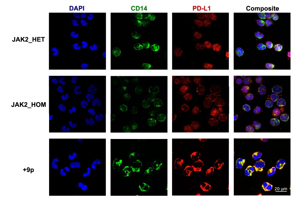 cancerscnews's tweet image. Chromosome 9p trisomy increases stem cells clonogenic potential and fosters T cell exhaustion in JAK2-mutant myeloproliferative #neoplasms, reports a team at @UNIMORE_univ, including Dr. Chiara Carretta.  
go.nature.com/4e0AVhH