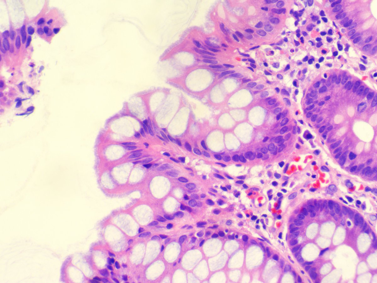 Case of the Week: A 62-year-old male with diverticular disease presents with diarrhea and abdominal pain. Diagnosis?