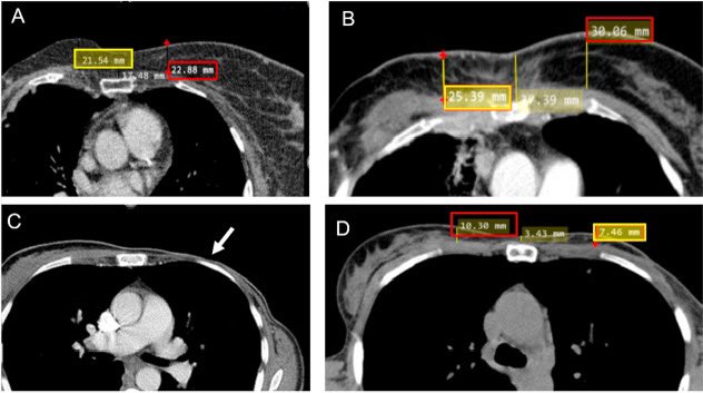 mastectomy 