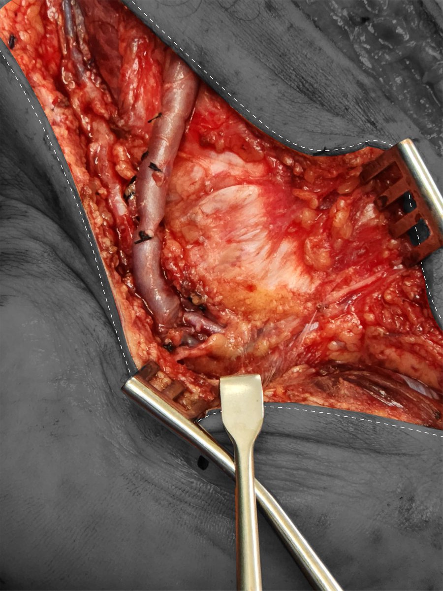 ReneLizola's tweet photo. Plantar bypass.
#GoDistal #Bypass #CLTIFighters https://t.co/sKAnZjTsGl