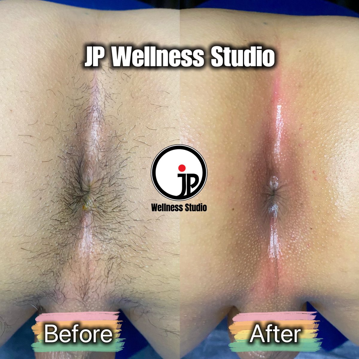 JP__wellness's tweet photo. Which one do you prefer? 😍
Buttcrack Waxing Treatment 🍑✨
Male Therapist, by appointment only 📲 WhatsApp (+6012-3257857)
#boyzilianwax #boyzilianwaxing #healthymanhood #hotwaxingspecialist #hotwaxingformen #maletherapist #hairremoval #phwaxing #jpws https://t.co/ssqOoYSph0