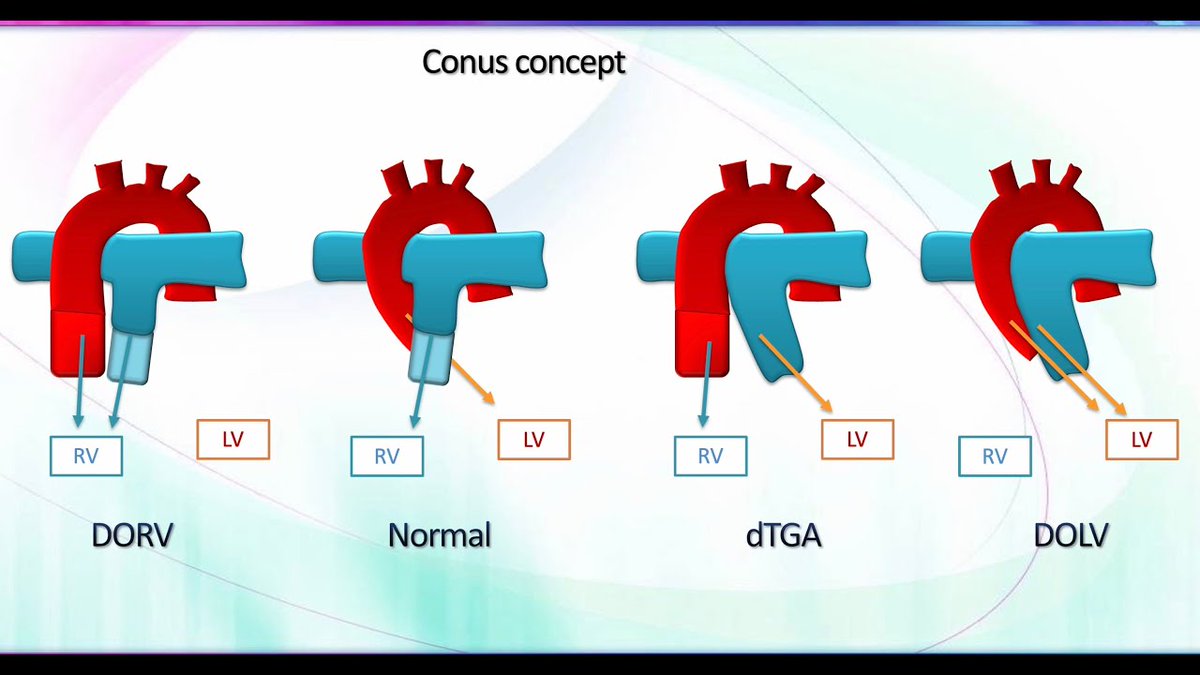 drupsinghin's tweet photo. Mastering Fetal Echo in Conotruncal Anomalies
Watch Now: https://t.co/VS81DU4W3C
#Fetalecho #conotruncal #echo #fourchamber #3vessel #overriding #pulmonarystenosis #TGA #TOF #tetralogy #Fallot #transposition #vsd #counselling #surgery #Arterialswitch #fetal https://t.co/NtDUdp62XN