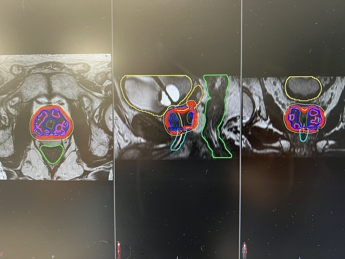 Steven J. Frank, MD (@sjfrankmd) on Twitter photo MRI-Assisted Radiosurgery - MARS LDR Brachytherapy - Optimizing quality assurance and increasing dose to dominant intraprostatic lesions while avoiding the external urethral sphincter (EUS) <a href="/MDAndersonNews/">MD Anderson Cancer Center</a> <a href="/ACKoongMDPhD/">Albert Koong, MD PhD</a> MRI-Assisted Radiosurgery - MARS LDR Brachytherapy - Optimizing quality assurance and increasing dose to dominant intraprostatic lesions while avoiding the external urethral sphincter (EUS) <a href="/MDAndersonNews/">MD Anderson Cancer Center</a> <a href="/ACKoongMDPhD/">Albert Koong, MD PhD</a>