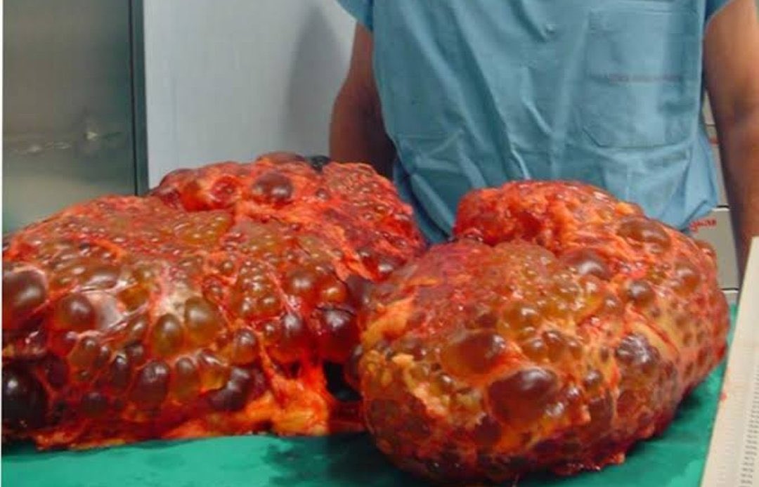 Drweloveu's tweet photo. The rate of kidney failure and disease are increasing amongst young people. Here are ways to protect the kidneys FREE OF CHARGE

Kindly share, A Thread: https://t.co/8V0m5cCx6W