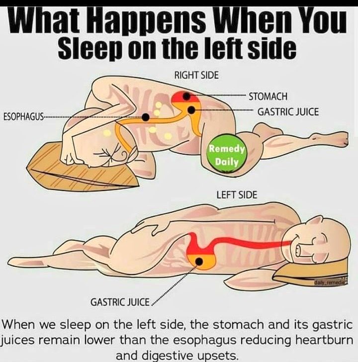 Lap_surgeon's tweet photo. बायी तरफ़ करवट ले कर सोये ताकि gastric juice और खाना वापिस Oesophagus में नहीं आये।
एसा करने से GERD (GastroEsophagealRefluxDisease) से बचा जा सकता है।

वीडियो में Severe GERD with Hiatus hernia दिखाया गया है।👇 https://t.co/j5ruGURfZo
