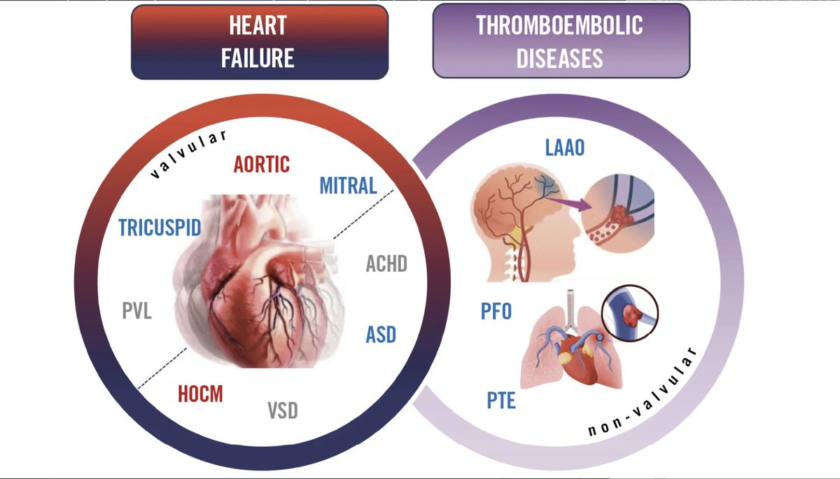 EAPCIPresident (@eapcipresident) on Twitter photo The #EAPCI Core Curriculum for Percutaneous Valvular & Structural Heart Intervention
Published in <a href="/EuroInterventio/">EuroIntervention</a> on the occasion of #ESCCongress 2024
Significant work from the #EAPCI Training & Certification Committee and collaborators.
bit.ly/3XowWGh The #EAPCI Core Curriculum for Percutaneous Valvular & Structural Heart Intervention
Published in <a href="/EuroInterventio/">EuroIntervention</a> on the occasion of #ESCCongress 2024
Significant work from the #EAPCI Training & Certification Committee and collaborators.
bit.ly/3XowWGh