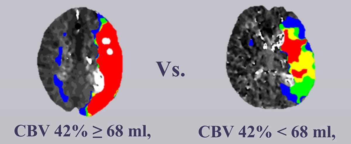 Dhairya A. Lakhani, MD (@dhairyalakhani) on Twitter photo rCBV<42% lesion volume of ≥68 ml predicts poor functional outcomes at 90 days in patients with anterior circulation LVO large-core strokes
DOI: 10.1161/STROKEAHA.124.047483
Led by <a href="/vsyedavalli/">Vivek Yedavalli, MD, MS, FAHA</a> & <a href="/hamza_isleem/">Hamza A. Salim, M.D.</a>
<a href="/yedavaSNAPlab/">Yedavalli SNAP Lab</a> rCBV<42% lesion volume of ≥68 ml predicts poor functional outcomes at 90 days in patients with anterior circulation LVO large-core strokes
DOI: 10.1161/STROKEAHA.124.047483
Led by <a href="/vsyedavalli/">Vivek Yedavalli, MD, MS, FAHA</a> & <a href="/hamza_isleem/">Hamza A. Salim, M.D.</a>
<a href="/yedavaSNAPlab/">Yedavalli SNAP Lab</a>