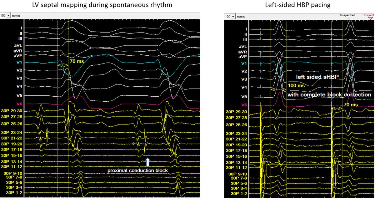 curilakarol (@curilakarol) on Twitter photo Clinical utility of LV septal mapping in CRT pt with QRS of uncertain meaning.
1/ Mapping identifies proximal trueLBBB. Its total correction during left-sided HBP (QRSd 100ms) excludes concomitant IVCD.
Thread continues...
<a href="/DrRoderickTung/">Roderick Tung</a> <a href="/ACisms/">Anthony C</a> <a href="/MargaridaPujol/">Margarida Pujol Lopez</a> <a href="/kvernooy/">Kevin Vernooy</a> Clinical utility of LV septal mapping in CRT pt with QRS of uncertain meaning.
1/ Mapping identifies proximal trueLBBB. Its total correction during left-sided HBP (QRSd 100ms) excludes concomitant IVCD.
Thread continues...
<a href="/DrRoderickTung/">Roderick Tung</a> <a href="/ACisms/">Anthony C</a> <a href="/MargaridaPujol/">Margarida Pujol Lopez</a> <a href="/kvernooy/">Kevin Vernooy</a>